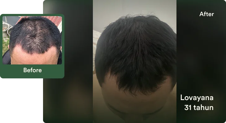 Cerita perjalanan treatment Bro Lovayana